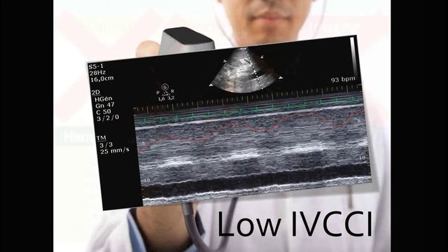 Malbrain Monitoring Deresuscitation ISICEM18 @Fluid Academy