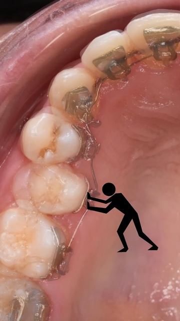Lingual braces