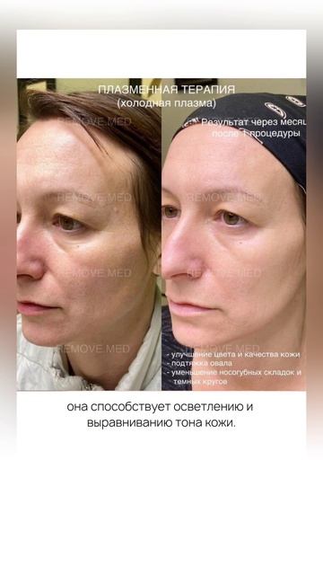 Холодная плазма и купероз.