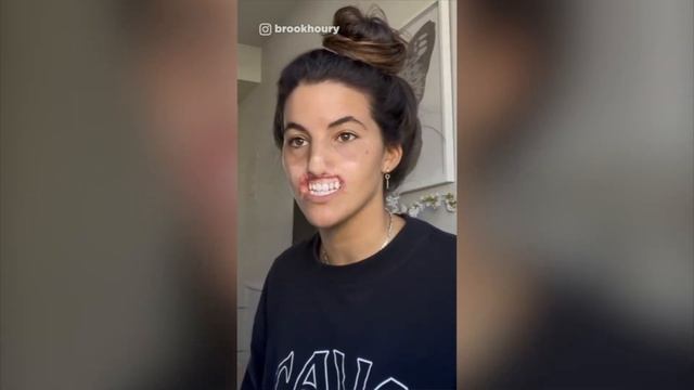 A Dog Tore My Lip Off
