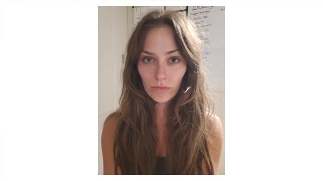 I Fixed my Volume Loss with Fillers and Meso Botox - My Wave Plastic Surgery Experience