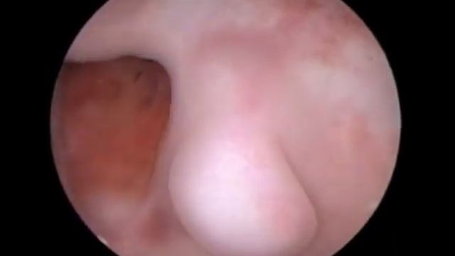 Vaginoscopy of cervical tears