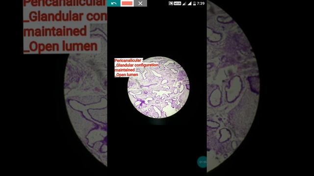 Fibroadenoma Histopathology