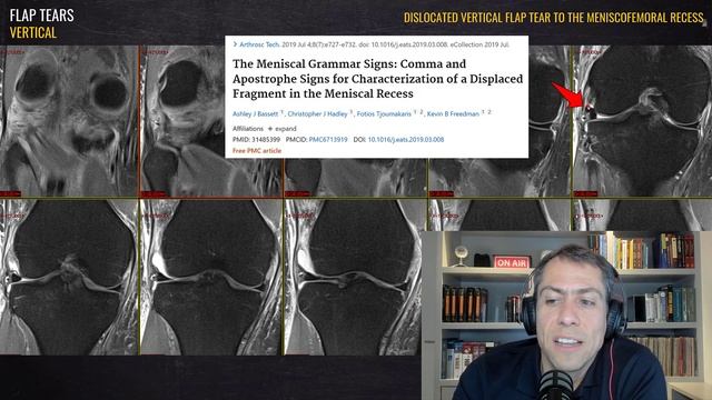 Meniscal Flap Tears on MRI