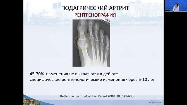 РМАПО Мезенова Т.В.  Подагра