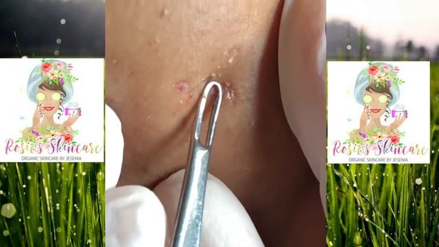 Satisfying Video,How to remove blackheads at home/milia 🌼🌷#4