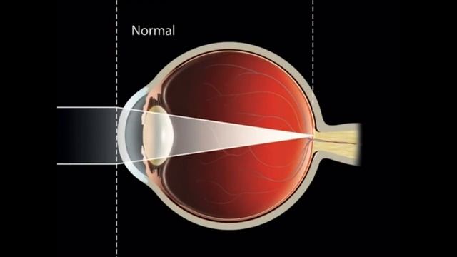 Myopia glasses