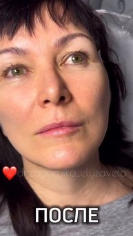 Подтяжка мезонитями / Dr.Elyzaveta_cosm