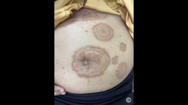 Tinea Corporis (Fungal Infection)