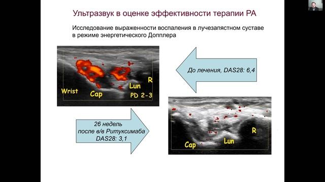 РМАПОВолков А.В.  УЗ диагностика РЗ