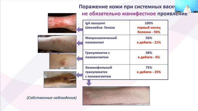 РМАПО  Бекетова Т.В.   Системные васкулиты 14 нозологических форм_ диагностика, лечение.