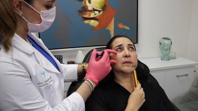Relleno de Ojeras y Pómulos con ácido hialurónico | Mujeres de 40 años y más