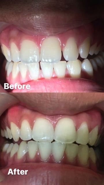 Diastema Closure