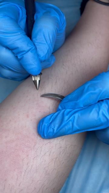 Электроэпиляция нитью