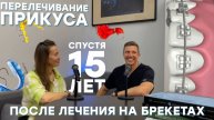 Перелечивание прикуса спустя 15 лет после лечения на брекетах🦷