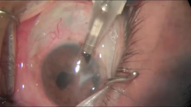 Texas First Iris Implant William E Sponsel MD