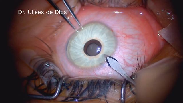 Cosmetic Iris Implants can cause severe ocular damage |  Eye colors change | Bright Ocular removal