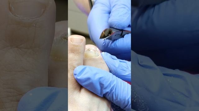 Обработка травмированного ногтя