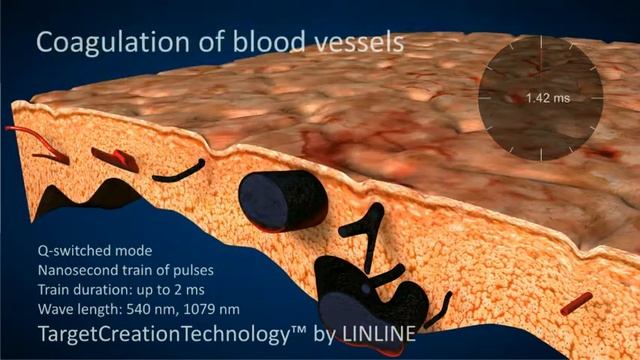 Blood vessels coagulation using the LINLINE™ method.