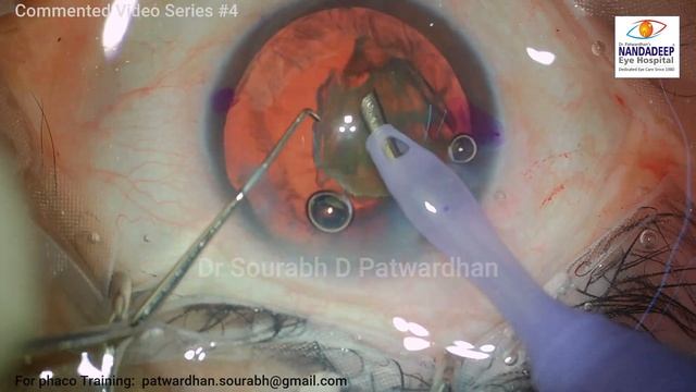 Commented #4 High Myopia Trifocal CTR Deep AC Dr Sourabh Patwardhan Nandadeep Eye Hospital,India