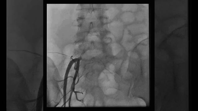 Retrograde filling of arteries by collaterals