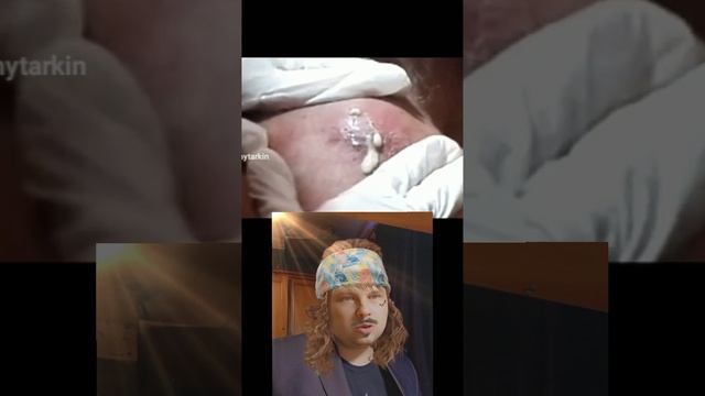 Удаление прыщей №1/человек насорог
