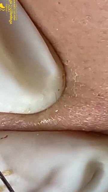 Great Blackheads Remover #288  #shorts