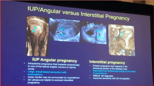 Ultrasound diagnosis of ectopic pregnancy
