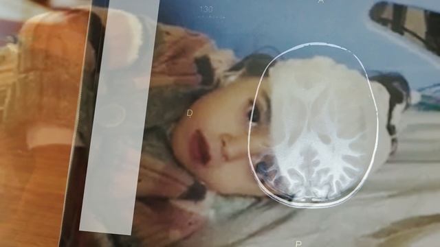 Histoire de la jeune Rita guérie de l'épilepsie