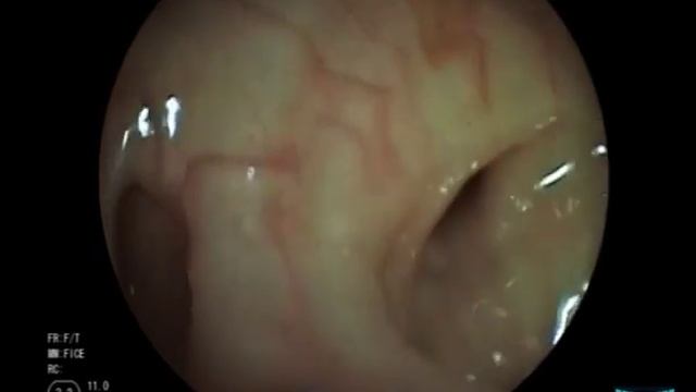 Colonic Diverticulosis