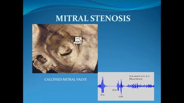 mitral stenosis