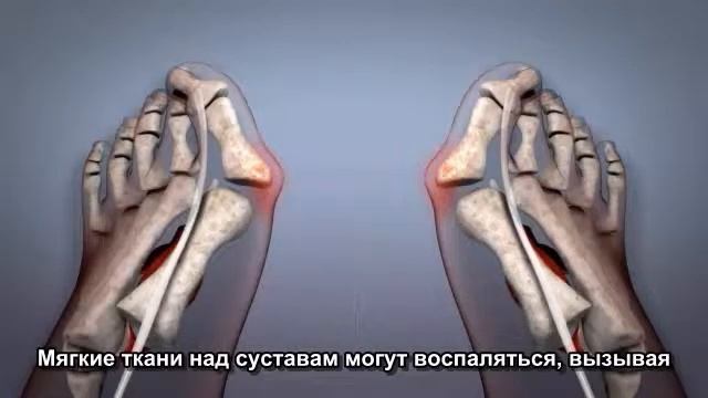 Что такое Hallux Valgus.avi