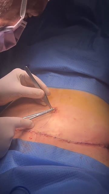 Abdominoplastia en Valencia Dr. julio Puig: retoque de la cicatriz y el ombligo