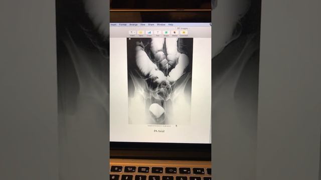 Barium Enema Overhead Image Evaluations