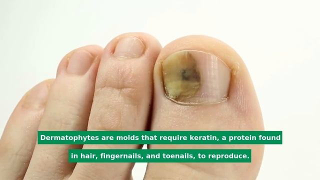 What is tinea unguium? | Your Healthy Lifestyle