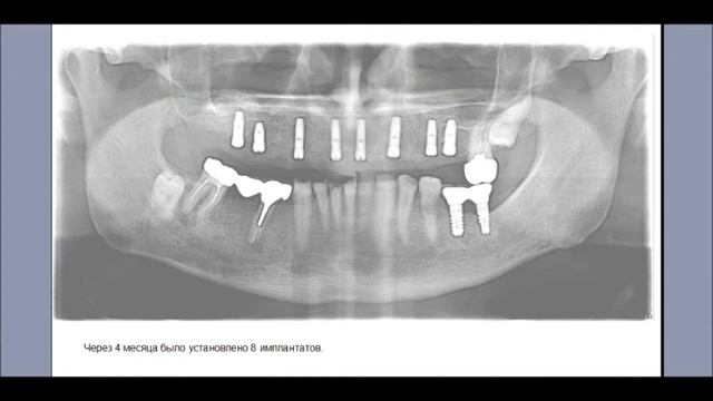 Имплантация зубов.