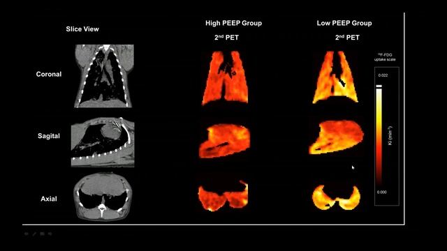 2018 Is there still a role for lung recruitment and open lung vent in ARDS A Mercat, M Amato