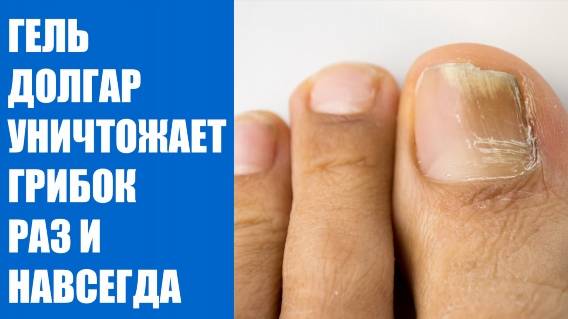 Какие народные средства от грибка 🤘 Полечить ногти на ногах ✔