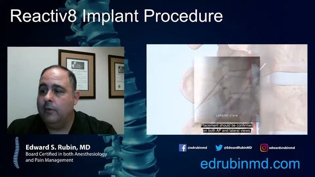 Reactiv8 Implant Procedure