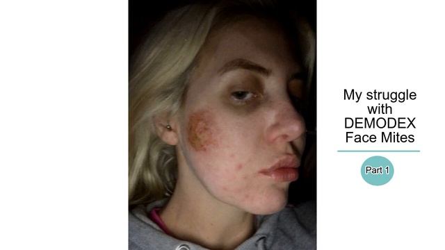 SHOCKING pics of My struggle with DEMODEX Face Mites - PART 1