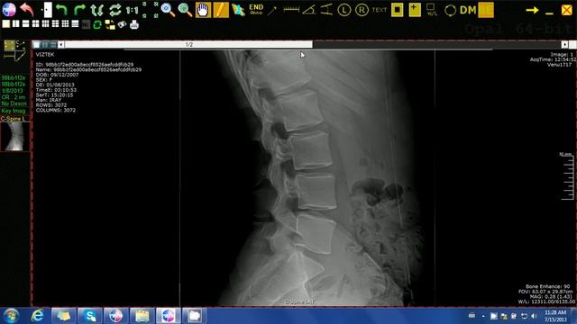 20/20 Imaging Opal-Rad (Chiropractic) Lumbar curve tool