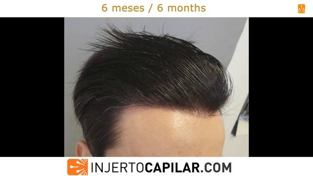2277 FUE Grafts. NW II. 2nd surgery to lower the hairline. 6 months. Injertocapilar.com. 2347/2019