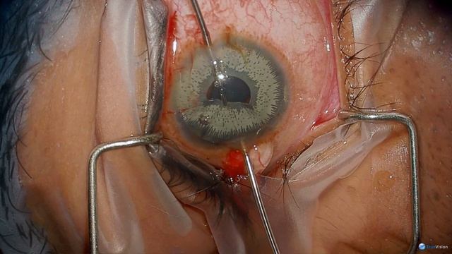 Trattler Cosmetic Iris Implant Removal
