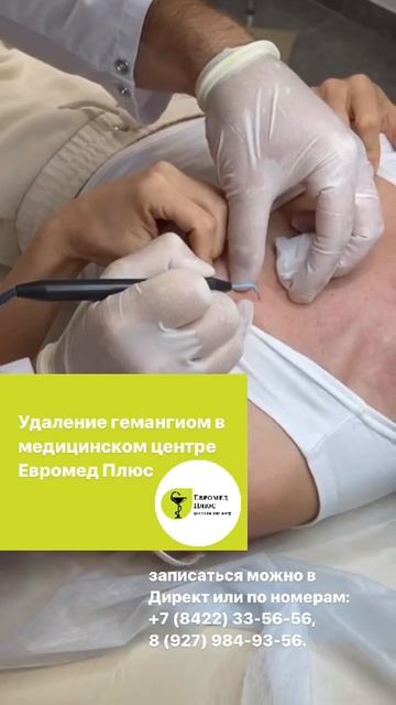 работа нашего хирурга — удаление родинок, гемангиом, бородавок» аппаратом «Сургитрон»