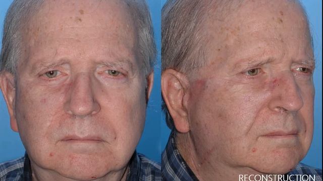 Reconstruction Case Study 1, from CW David Chang, MD, Columbia Facial Plastic Surgery