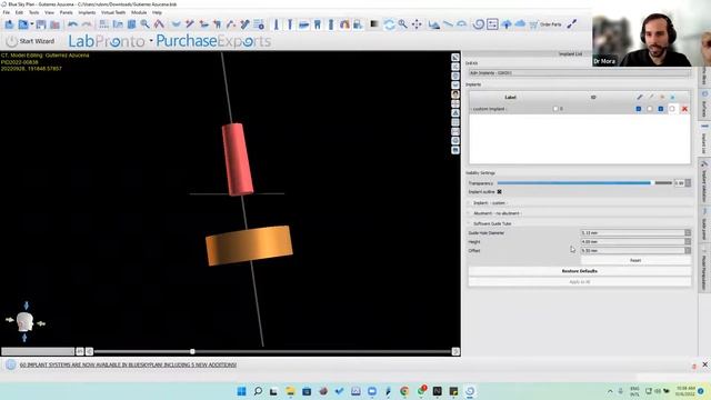 Surgical Guide for Custom Implant and custom drill hole using  blue sky bio