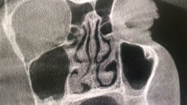 Deviated Nasal Septum explained with Cone Beam CT scan