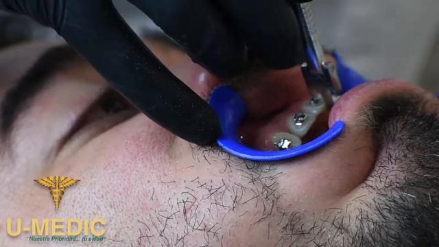 Procedimiento de cementado de brackets de autoligado