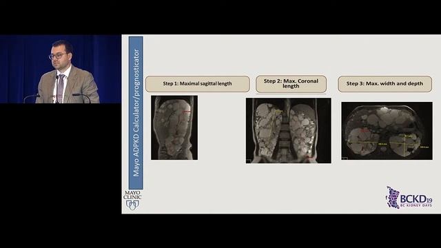 Advances in Management of ADPKD: A Comprehensive Approach - BC Kidney Days 2019