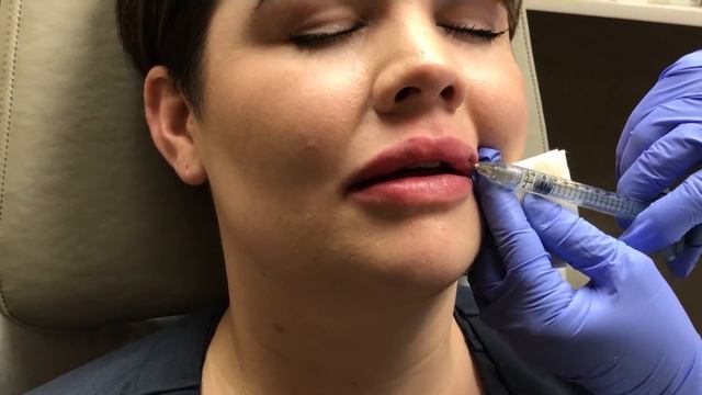 Juvederm Lip Filler Treatment - Laser & Skin Surgery Center of Northern California